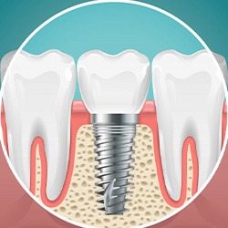 Graphic of a dental implant fusing with the jawbone