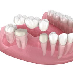 Illustration of traditional dental bridge being placed on teeth