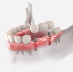 Illustration of implant bridge being placed in lower dental arch