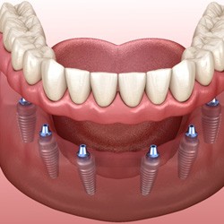 diagram of implant dentures