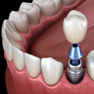 Illustration of single dental implant