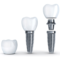 dental implant post, abutment, and crown