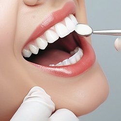 Woman opening her mouth after veneers are firmly placed
