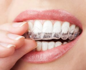 Invisalign clear aligners move teeth into healthier and better-looking alignment. Your Newburyport dentists can tell you if they’ll work for you.