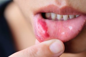 child canker sore on lip