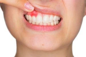 Woman pointing to her inflamed gums