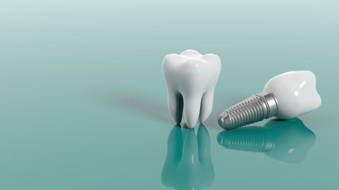 examples of dental implants