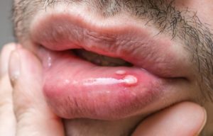 person with a canker sore on their lip