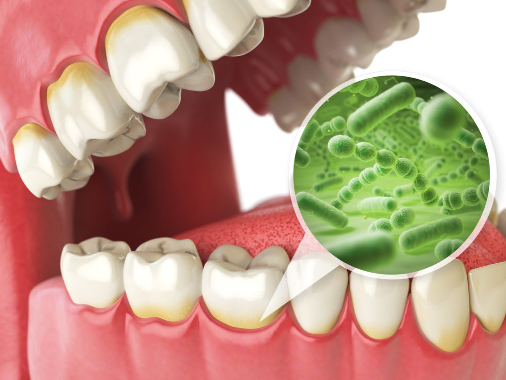 Bacteria that cause gum disease cause damage below the gum line.