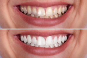 A comparison of a woman’s smile before and after teeth whitening