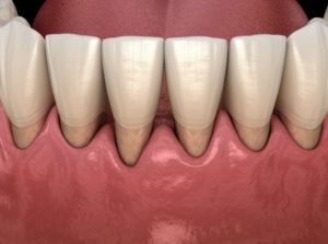 Model of advanced gum disease